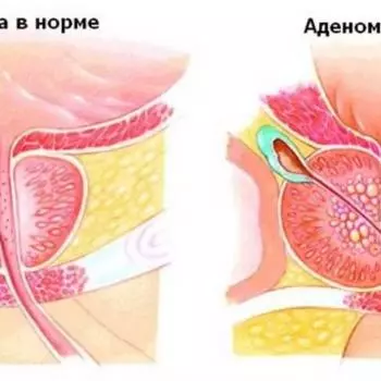 Аденома простаты. Лечение
